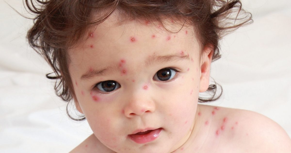 chicken pox in kids